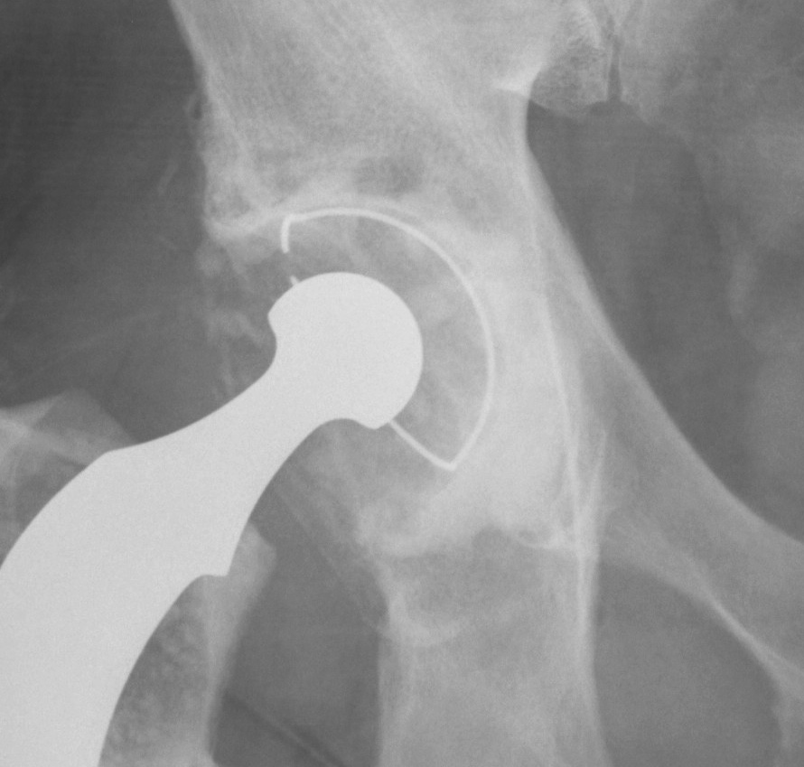 Revison THR Type I Acetabulum